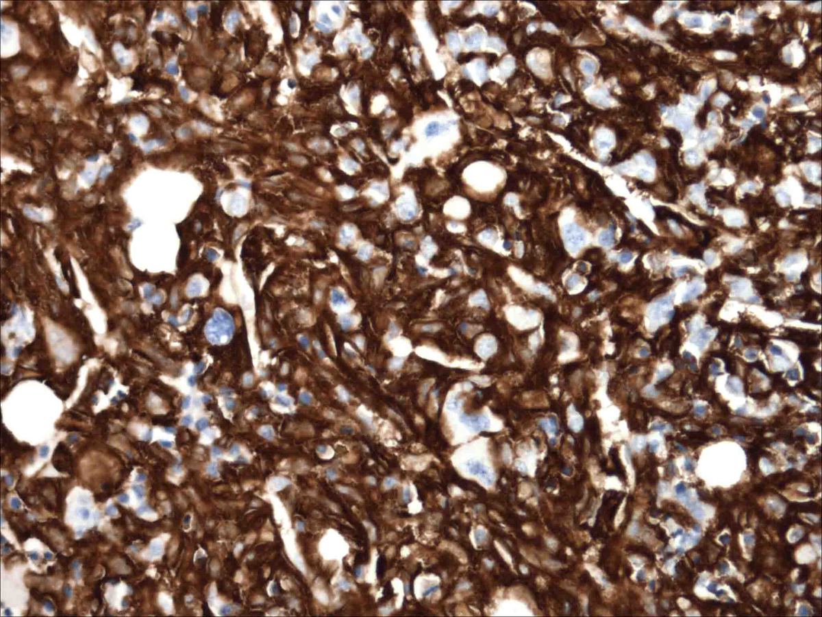 Bone marrow biopsy 8 months after T-ALL diagnosis, CD163.